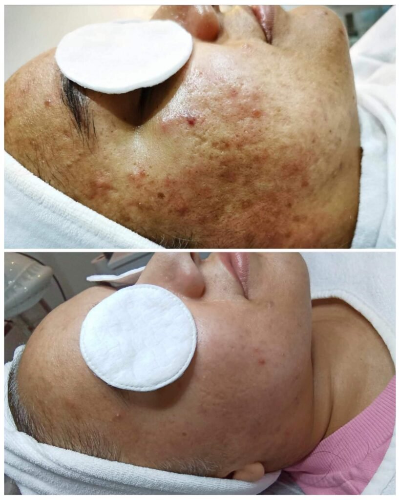 Chemical Peel