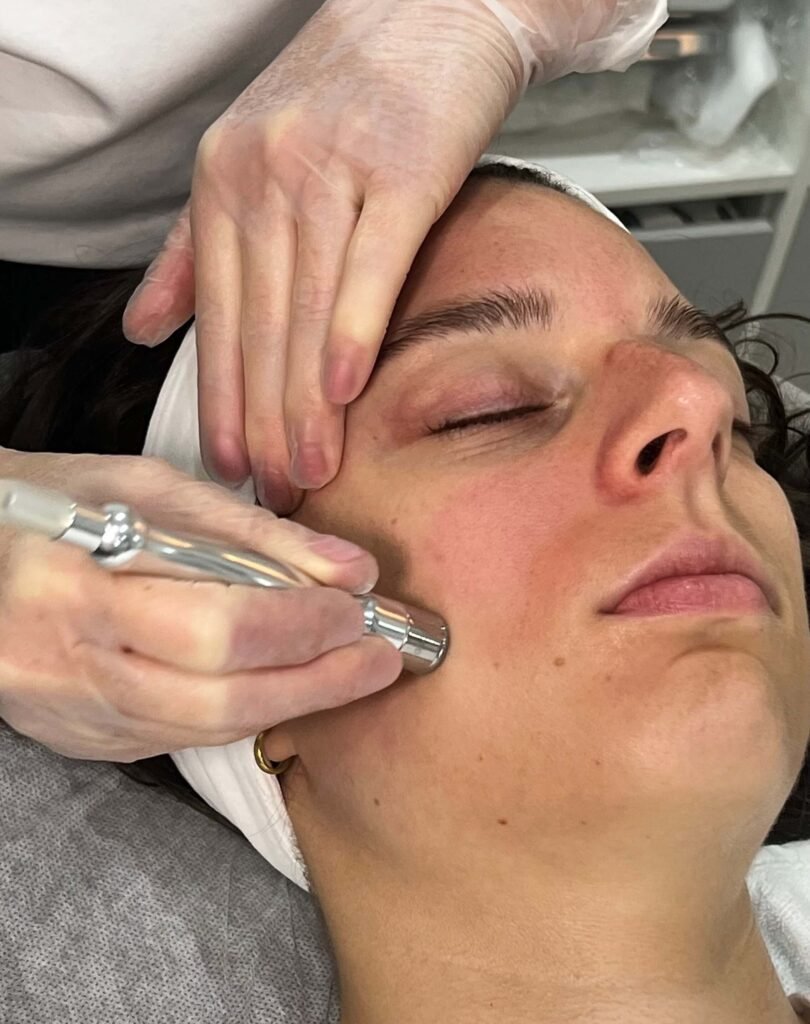 Diamond Microdermabrasion