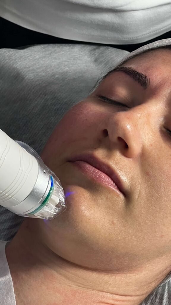 RF Microneedling treatment